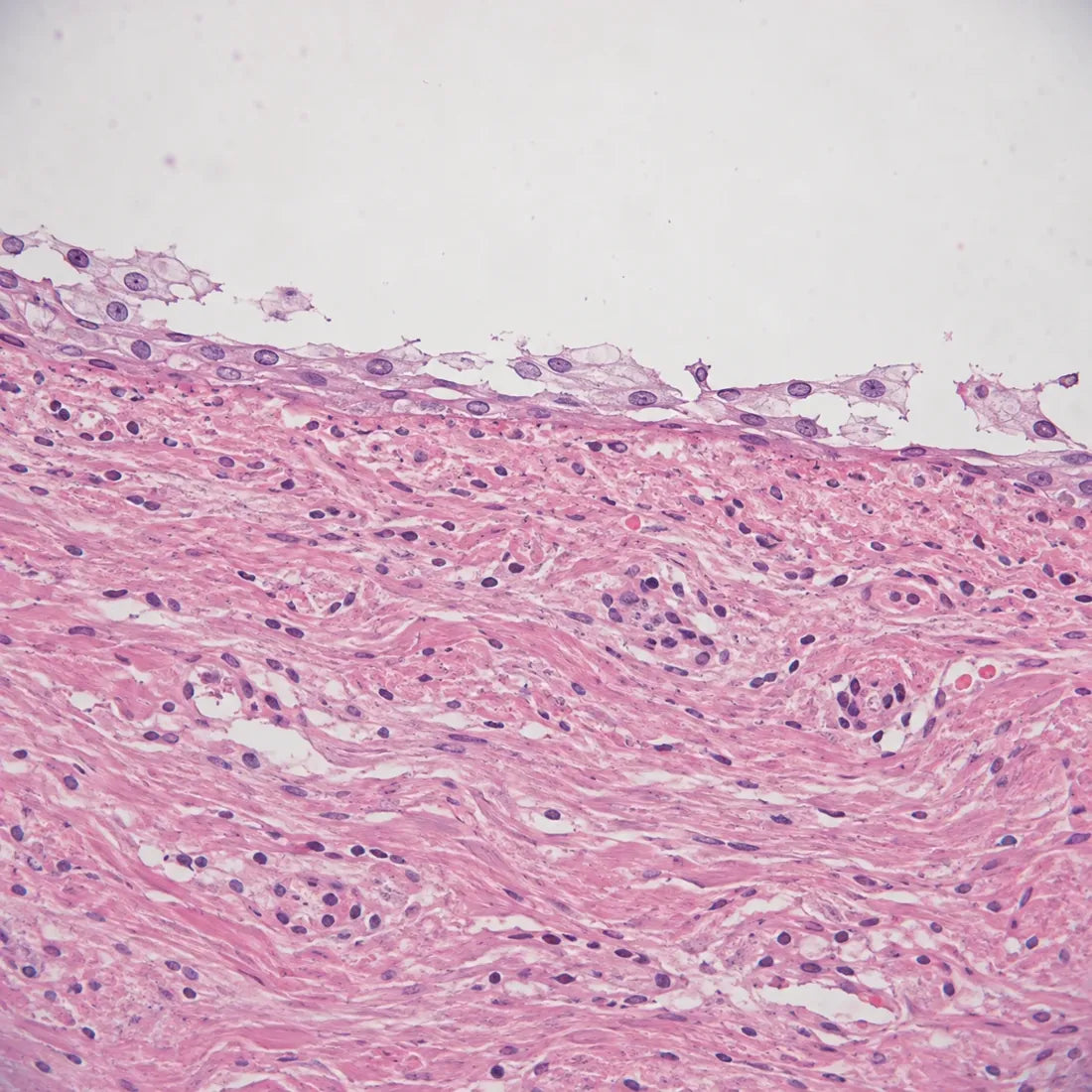 Thin, fragmented vaginal tissue under a microscope